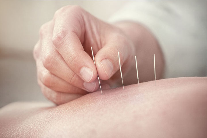 Akupunktur